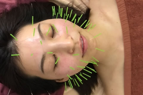 八方美容針のイメージ